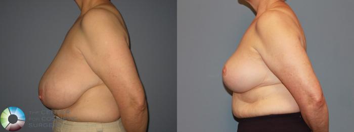 Before & After Breast Reduction Case 483 View #3 View in Golden, CO