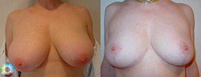 Before & After Breast Reduction Case 510 View #1 in Denver, CO