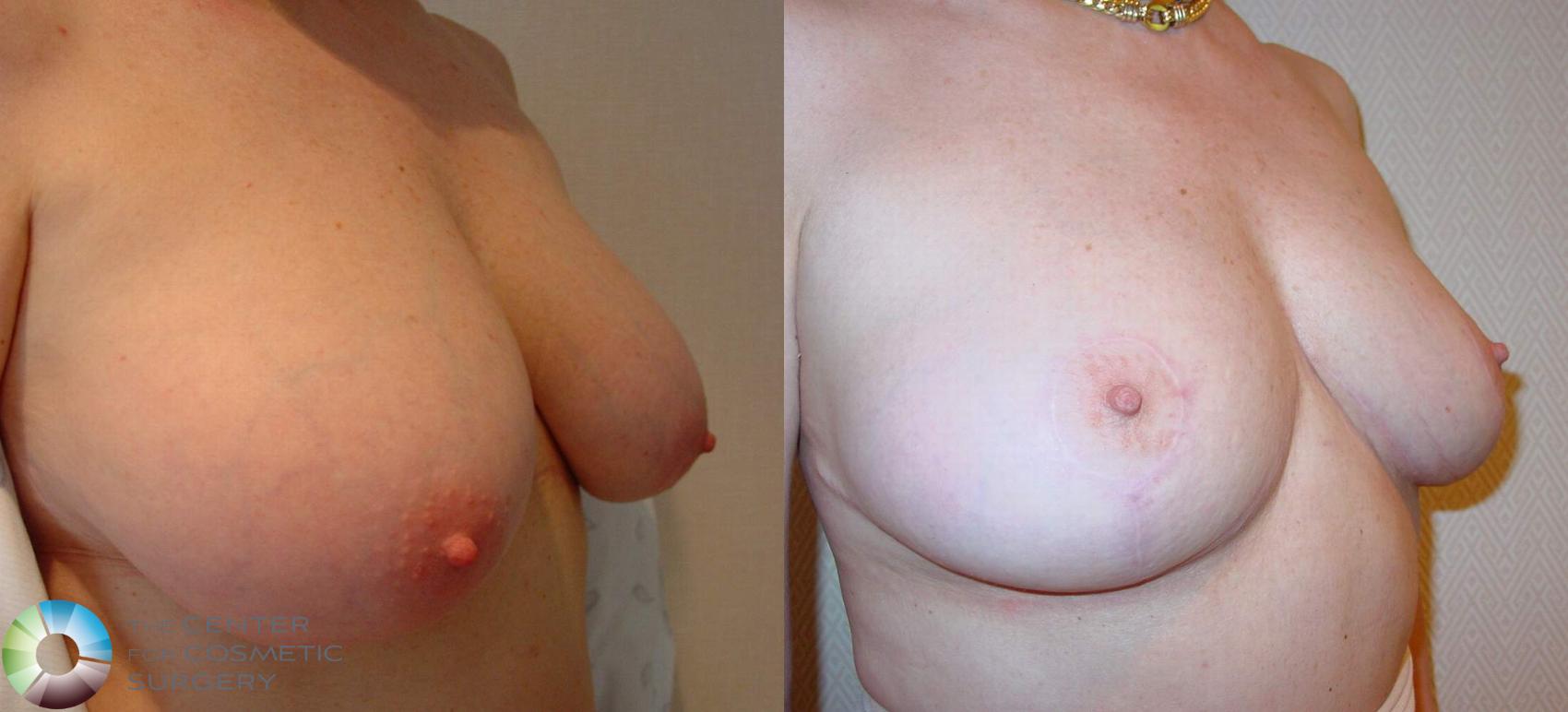 Before & After Breast Reduction Case 510 View #2 in Denver and Colorado Springs, CO