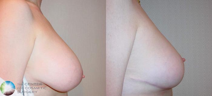 Before & After Breast Reduction Case 510 View #3 in Denver, CO