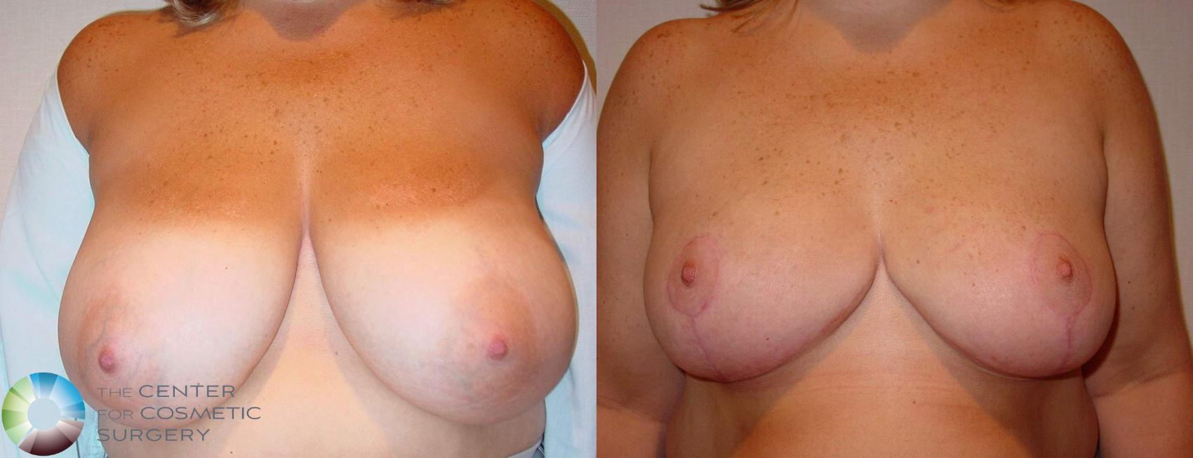 Before & After Breast Reduction Case 511 View #1 in Denver and Colorado Springs, CO