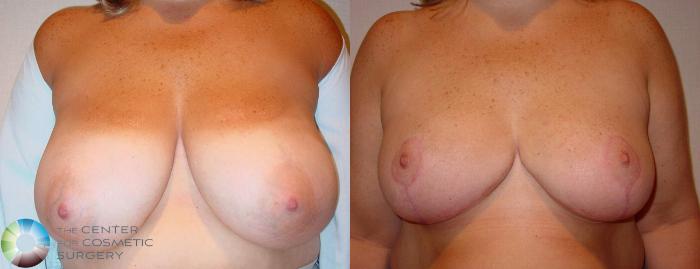 Before & After Breast Reduction Case 511 View #1 View in Golden, CO