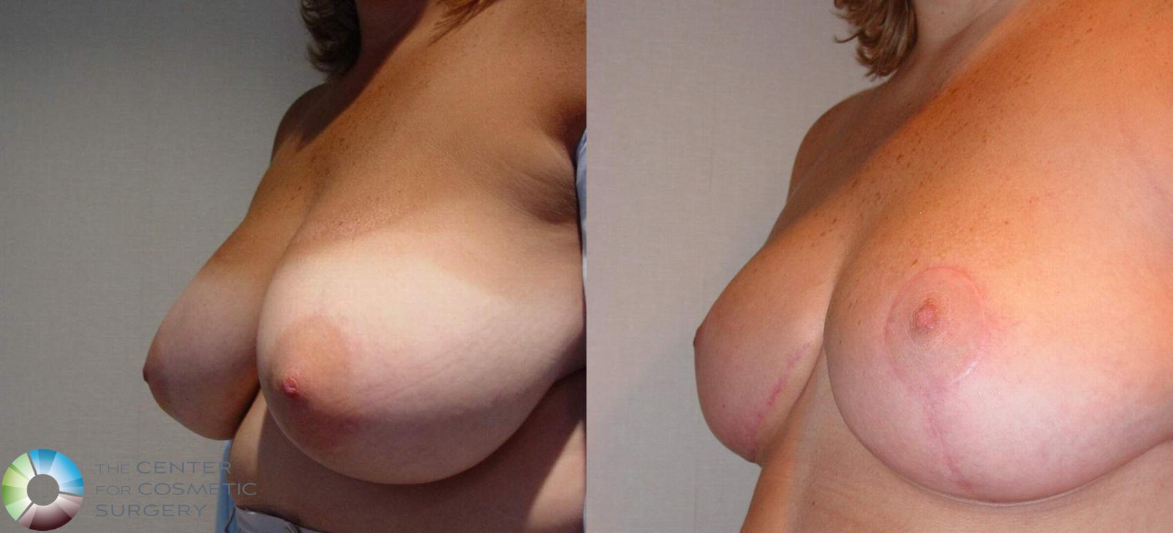 Before & After Breast Reduction Case 511 View #2 in Denver and Colorado Springs, CO