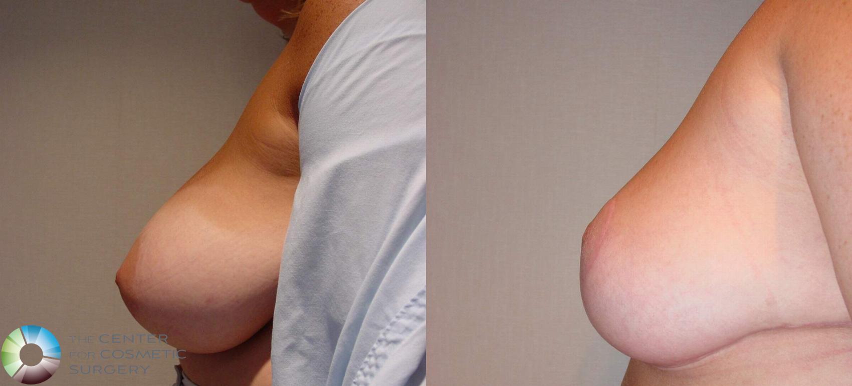 Before & After Breast Reduction Case 511 View #3 in Denver and Colorado Springs, CO