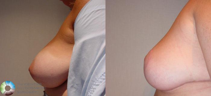 Before & After Breast Reduction Case 511 View #3 View in Golden, CO
