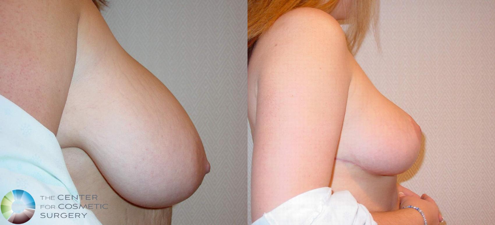 Before & After Breast Reduction Case 517 View #3 View in Golden, CO