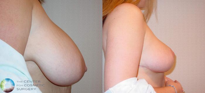 Before & After Breast Reduction Case 517 View #3 in Denver, CO