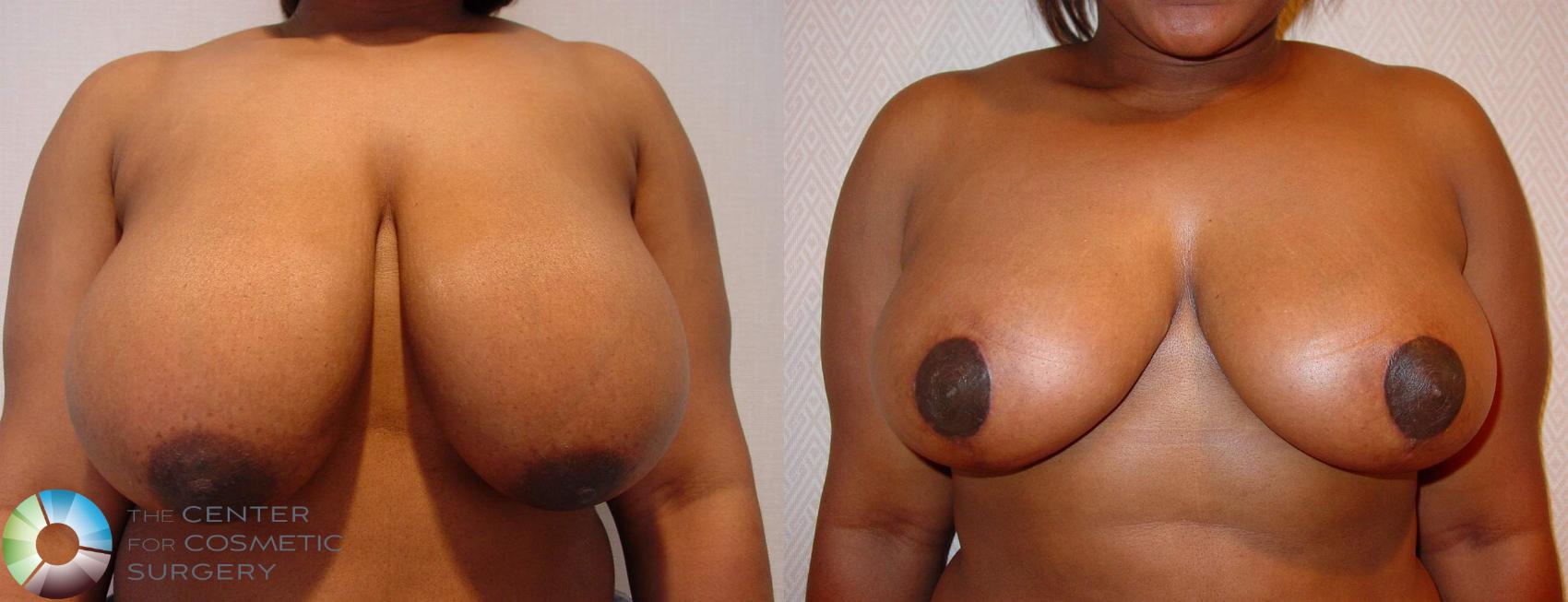 Before & After Breast Reduction Case 518 View #1 in Denver and Colorado Springs, CO