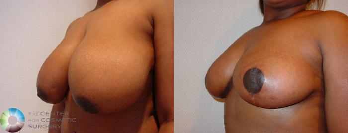 Before & After Breast Reduction Case 518 View #2 View in Golden, CO