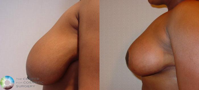 Before & After Breast Reduction Case 518 View #3 View in Golden, CO