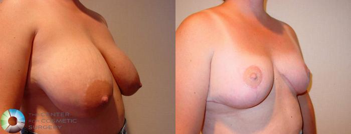 Before & After Breast Reduction Case 519 View #1 in Denver and Colorado Springs, CO