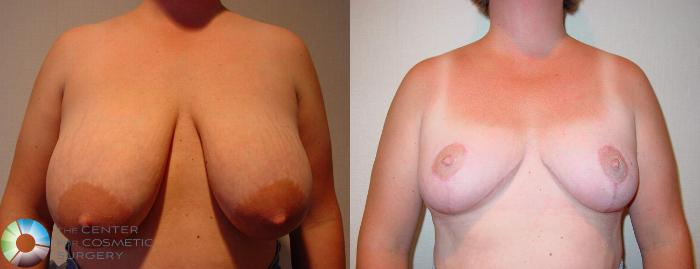 Before & After Breast Reduction Case 519 View #2 in Denver and Colorado Springs, CO