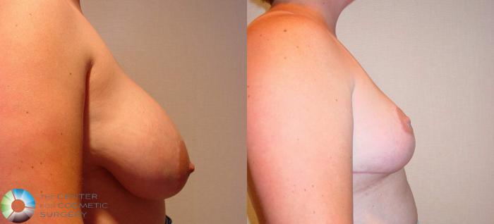Before & After Breast Reduction Case 519 View #3 in Denver and Colorado Springs, CO