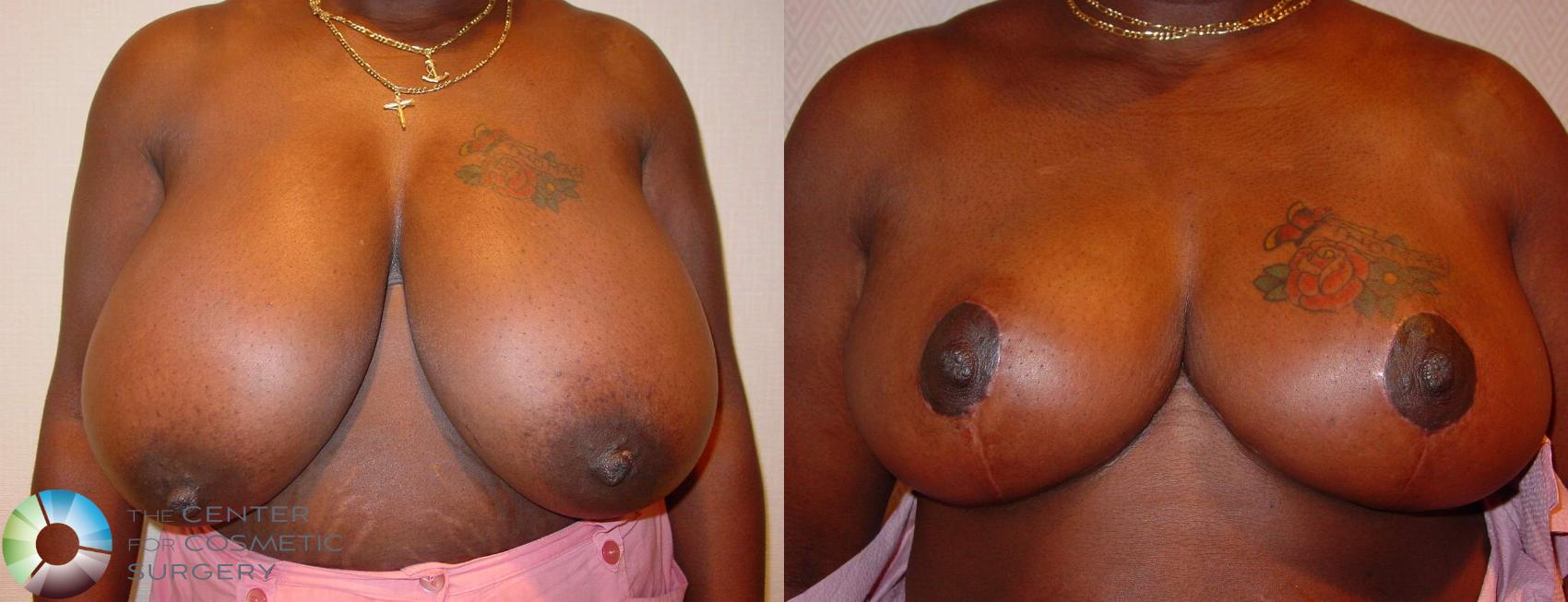 Before & After Breast Reduction Case 520 View #1 in Denver, CO