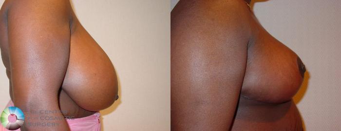 Before & After Breast Reduction Case 520 View #2 in Denver, CO