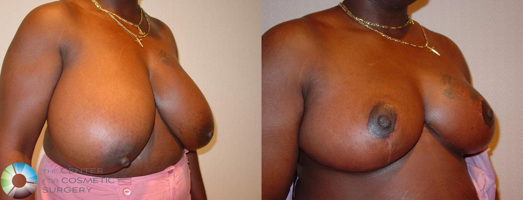 Before & After Breast Reduction Case 520 View #3 View in Golden, CO