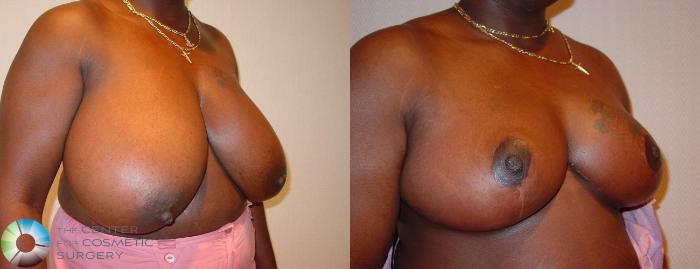 Before & After Breast Reduction Case 520 View #3 in Denver, CO