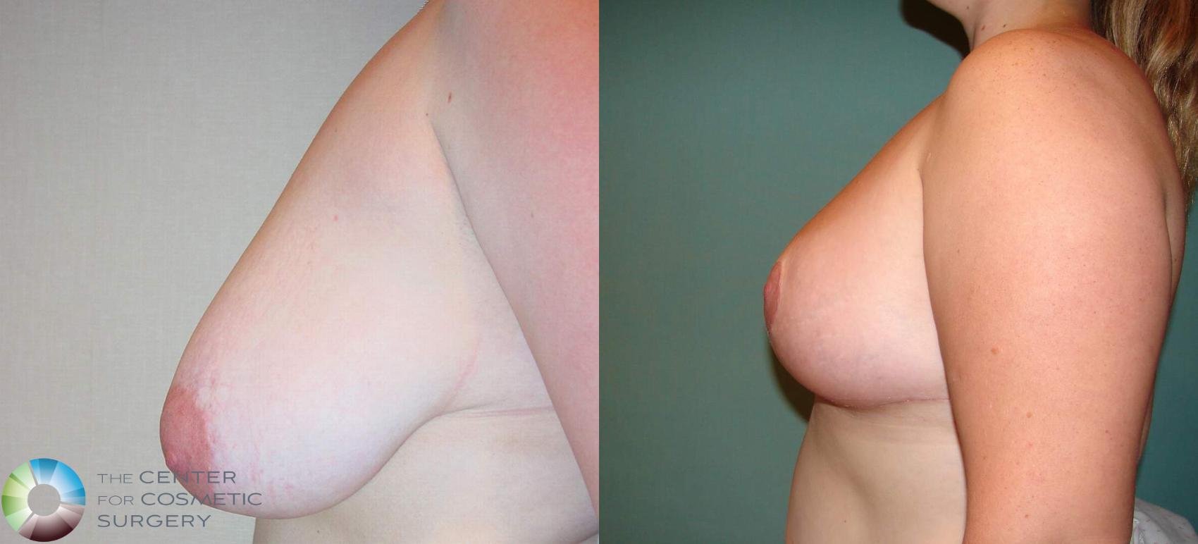 Before & After Breast Reduction Case 521 View #2 View in Denver & Golden, CO