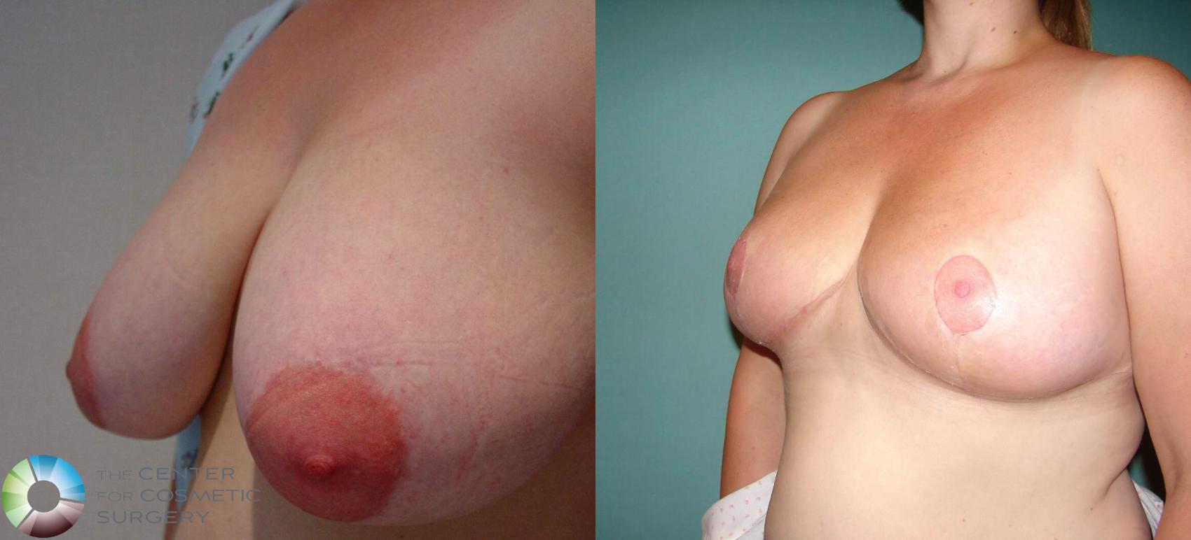 Before & After Breast Reduction Case 521 View #3 View in Denver & Golden, CO