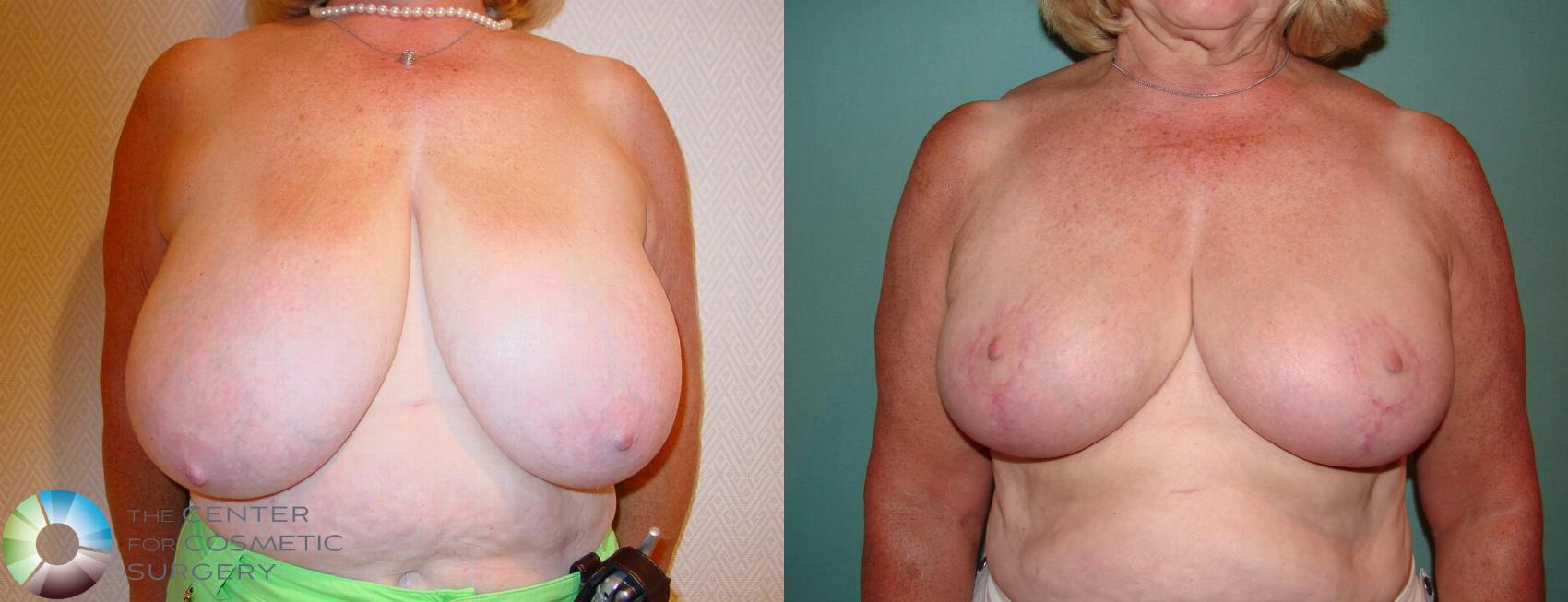 Before & After Breast Reduction Case 522 View #1 in Denver and Colorado Springs, CO