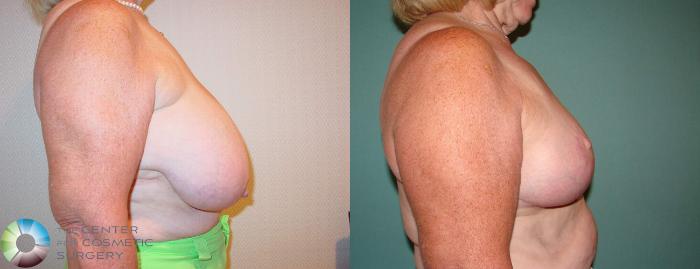 Before & After Breast Reduction Case 522 View #2 View in Golden, CO
