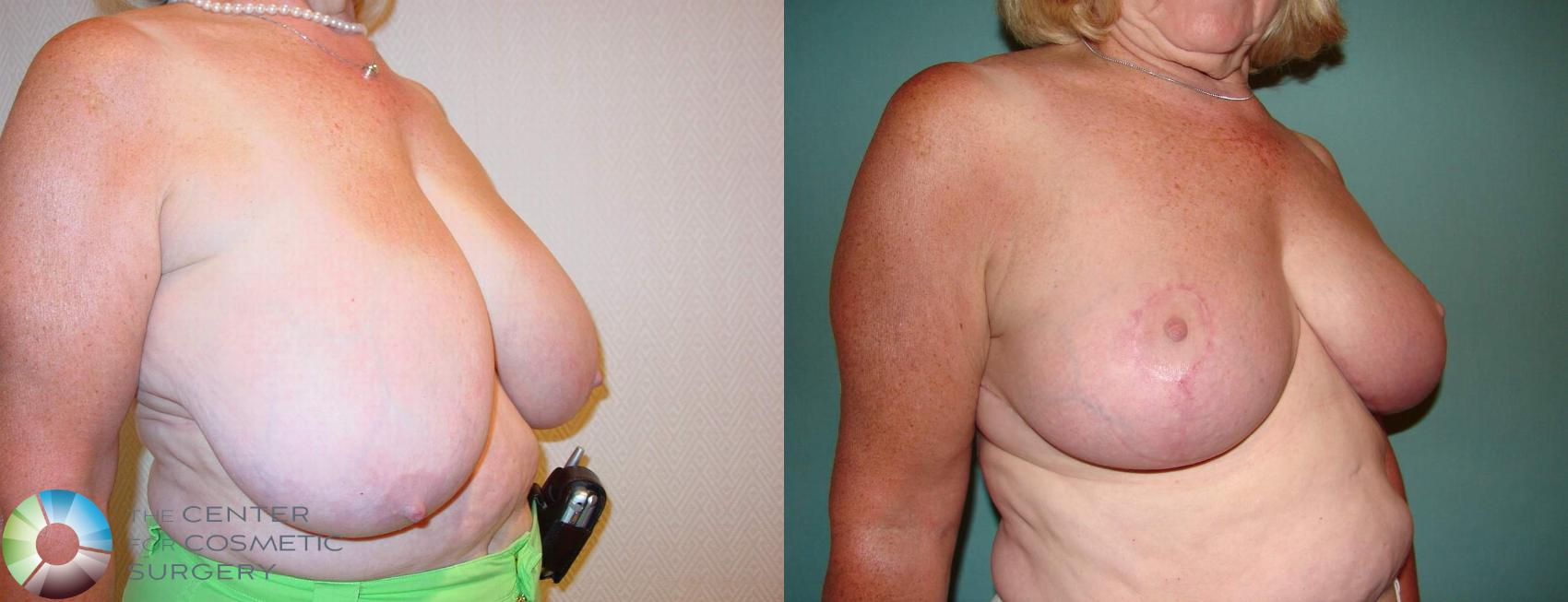 Before & After Breast Reduction Case 522 View #3 View in Denver & Golden, CO