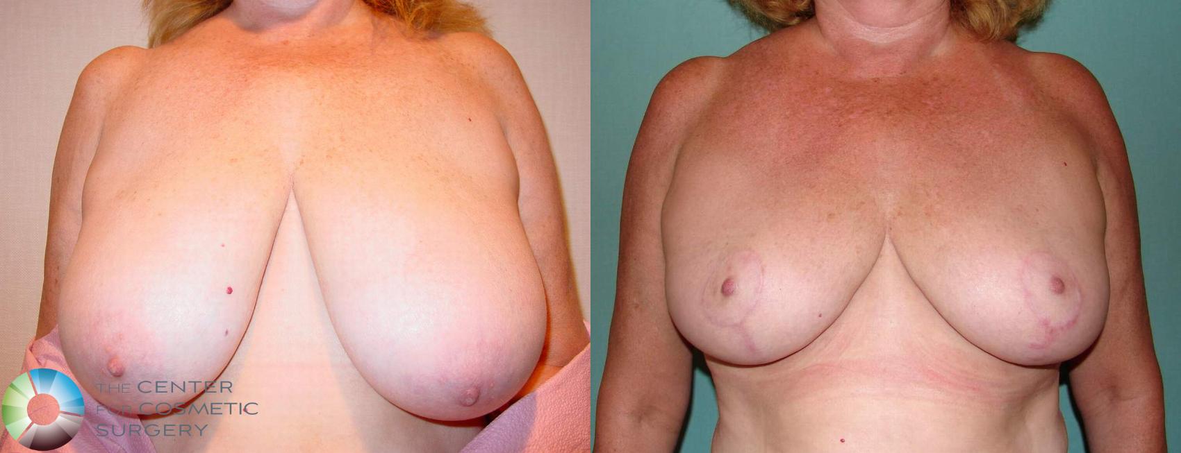 Before & After Breast Reduction Case 523 View #1 in Denver, CO
