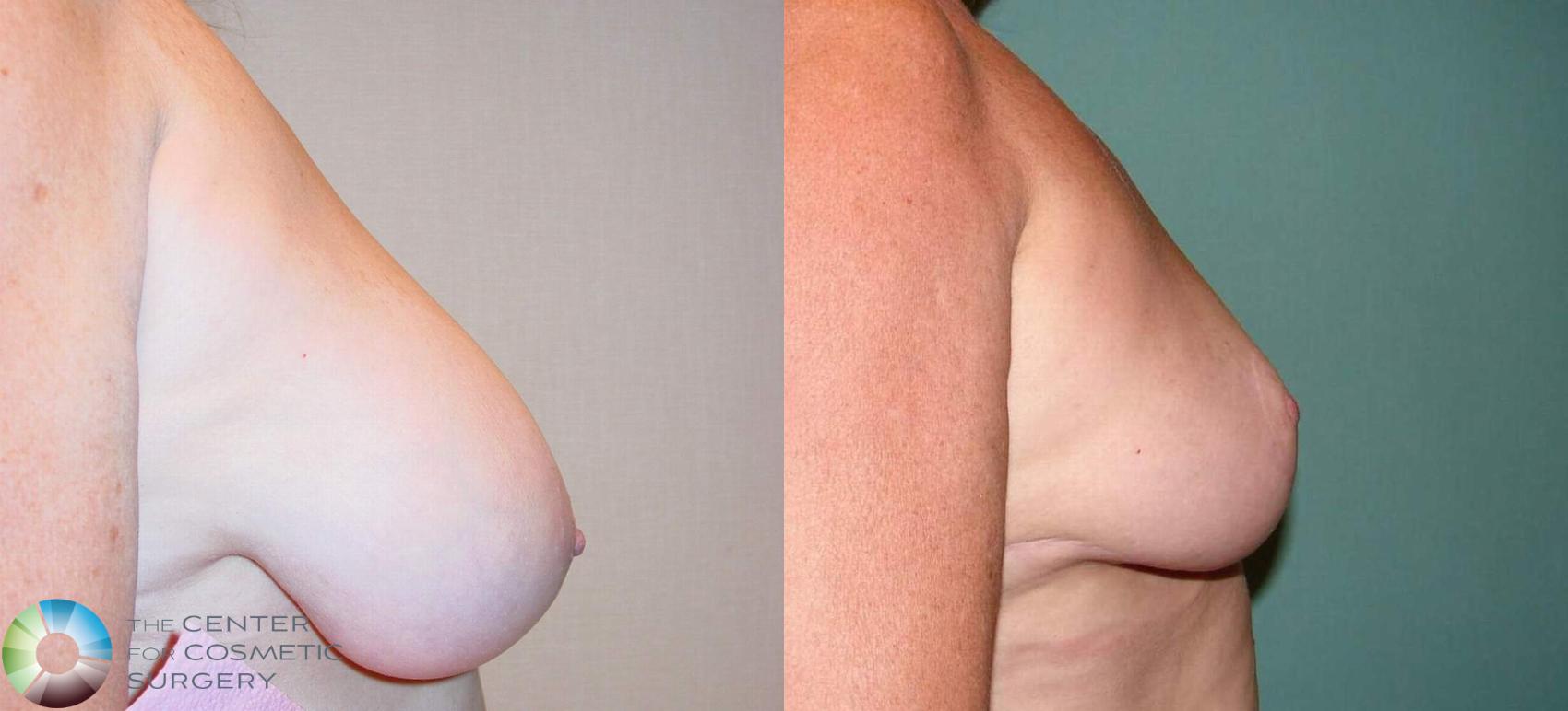 Before & After Breast Reduction Case 523 View #2 in Denver and Colorado Springs, CO