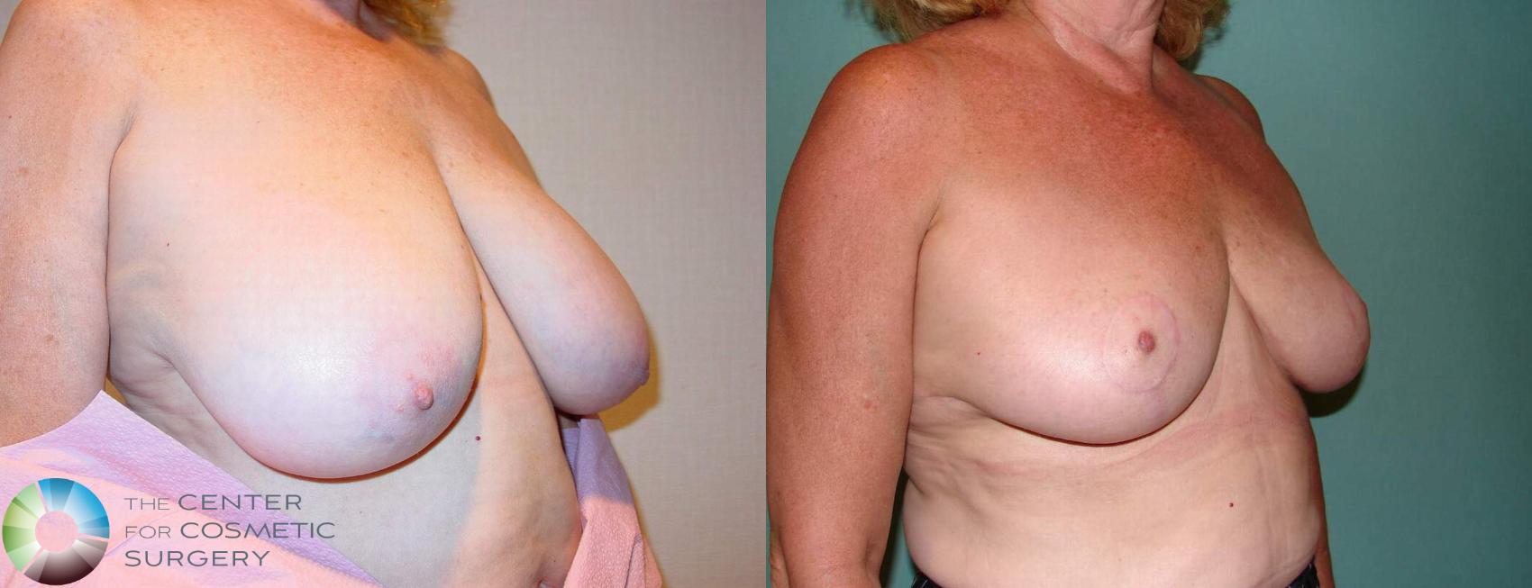 Before & After Breast Reduction Case 523 View #3 in Denver and Colorado Springs, CO