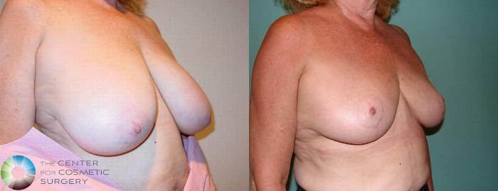 Before & After Breast Reduction Case 523 View #3 in Denver, CO