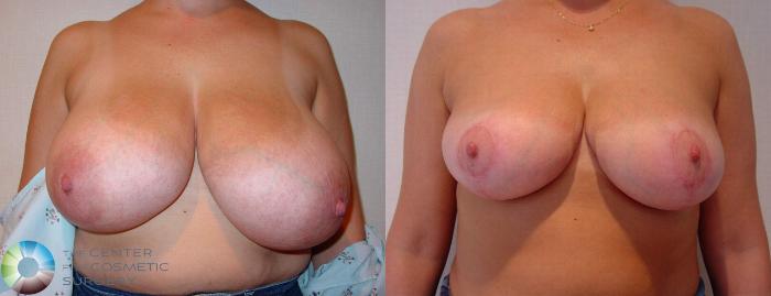 Before & After Breast Reduction Case 526 View #1 in Denver and Colorado Springs, CO