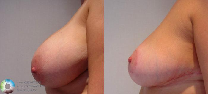 Before & After Breast Reduction Case 526 View #2 in Denver and Colorado Springs, CO
