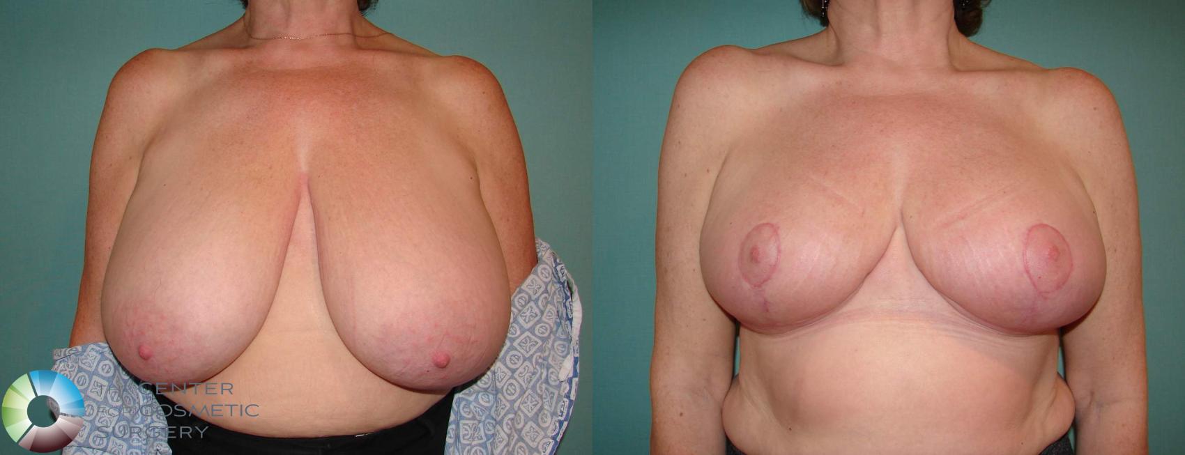 Before & After Breast Reduction Case 533 View #1 in Denver, CO