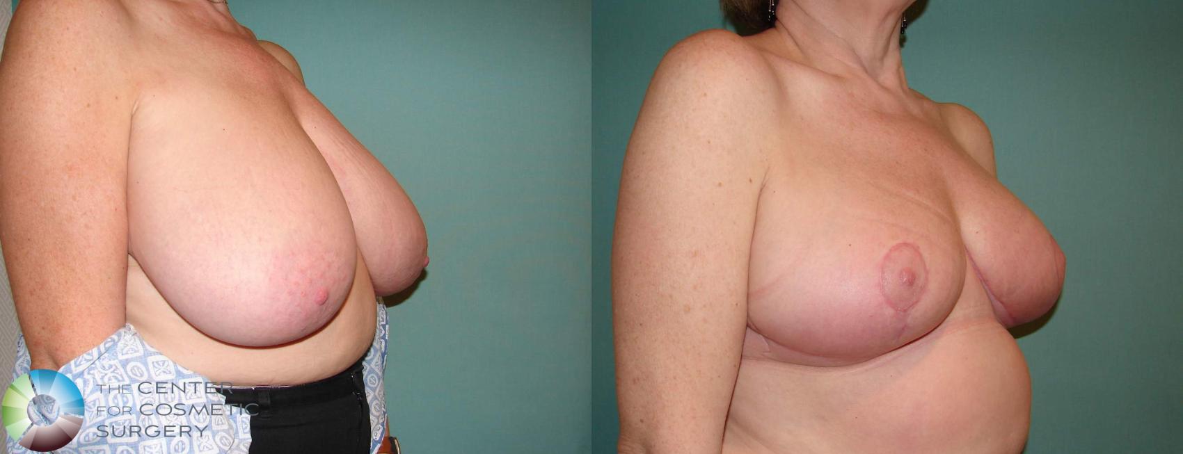 Before & After Breast Reduction Case 533 View #2 View in Golden, CO