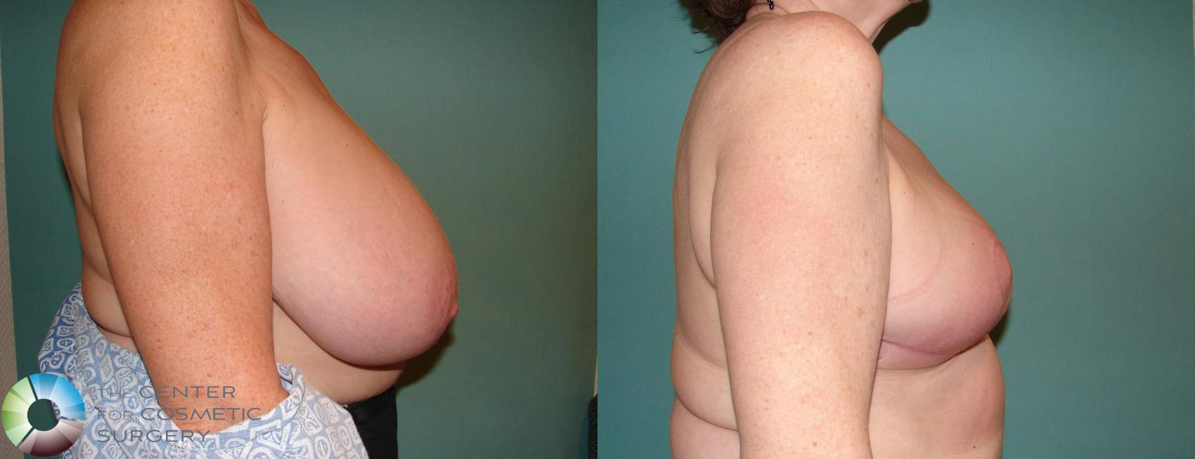 Before & After Breast Reduction Case 533 View #3 View in Denver & Golden, CO