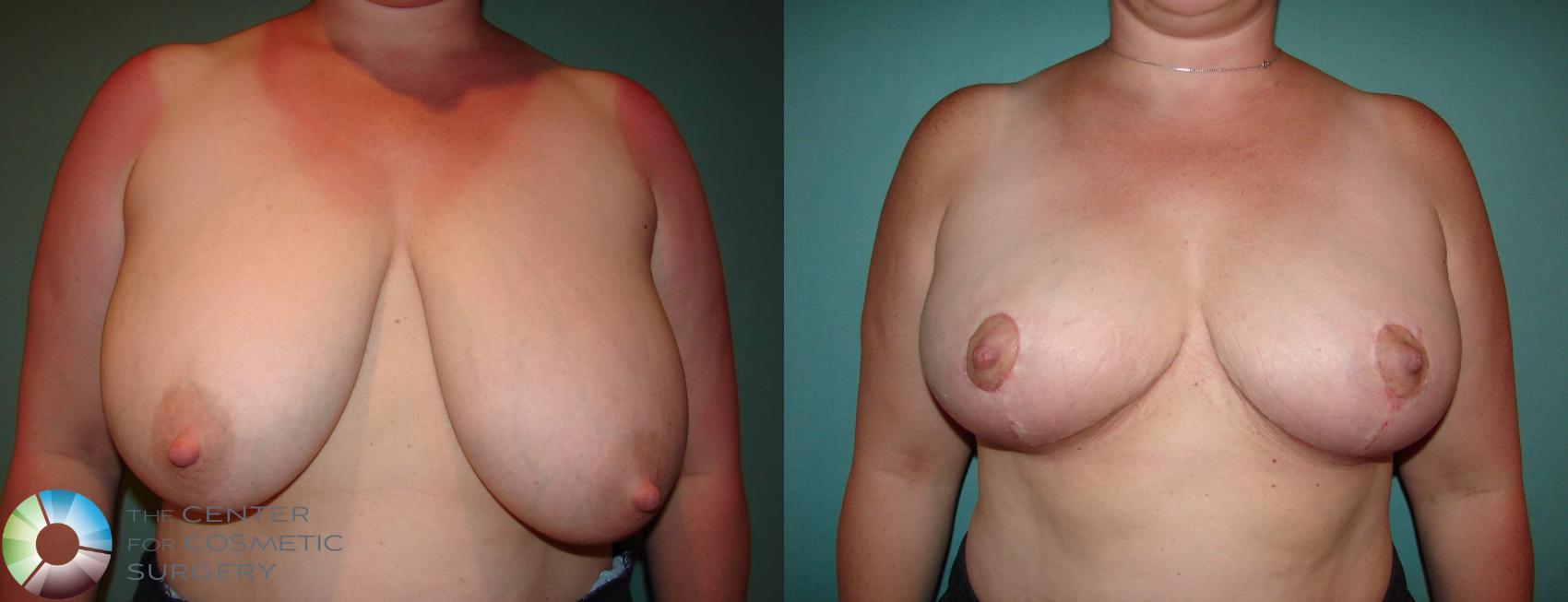 Before & After Breast Reduction Case 535 View #1 in Denver and Colorado Springs, CO