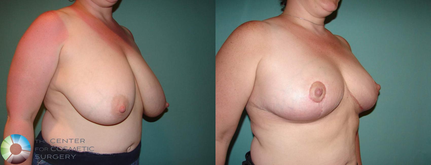 Before & After Breast Reduction Case 535 View #2 in Denver and Colorado Springs, CO