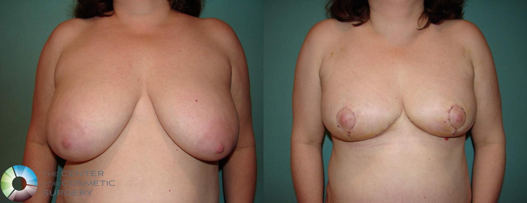 Before & After Breast Reduction Case 545  in Denver and Colorado Springs, CO