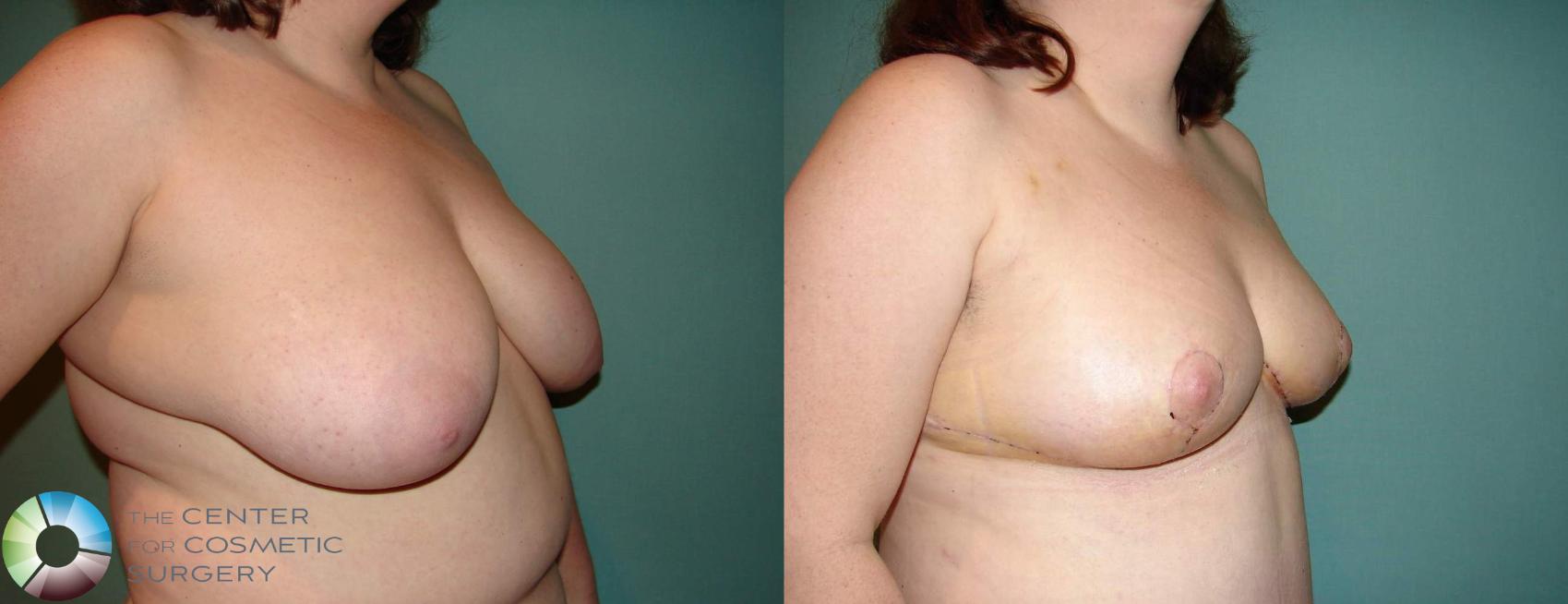 Before & After Breast Reduction Case 545  in Denver and Colorado Springs, CO