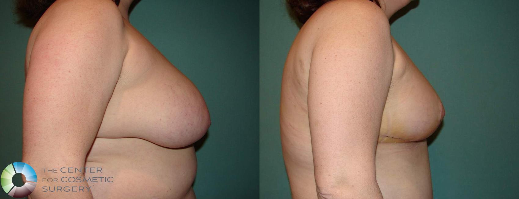 Before & After Breast Reduction Case 545  in Denver and Colorado Springs, CO
