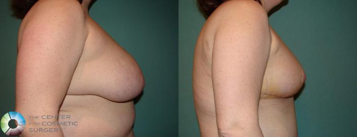 Before & After Breast Reduction Case 545 View 3 View in Golden, CO