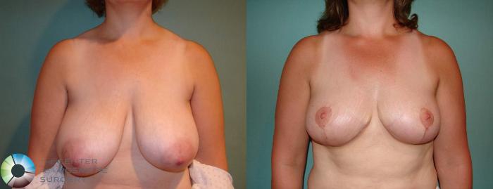Before & After Breast Reduction Case 546 View #1 in Denver and Colorado Springs, CO