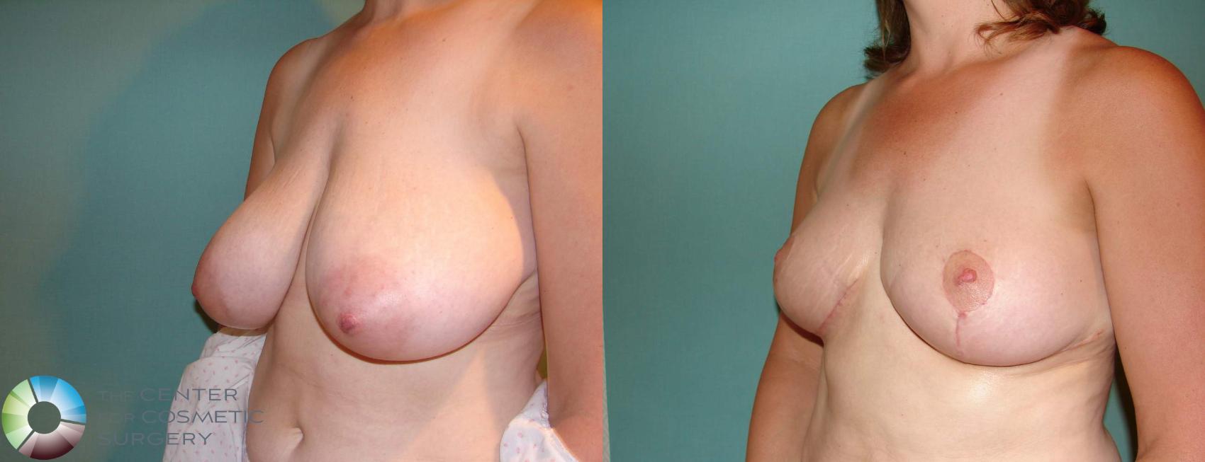 Before & After Breast Reduction Case 546 View #2 View in Golden, CO