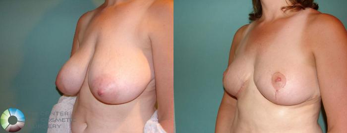 Before & After Breast Reduction Case 546 View #2 in Denver and Colorado Springs, CO