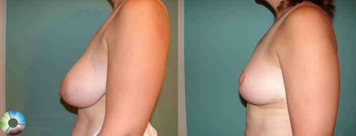 Before & After Breast Reduction Case 546 View #3 in Denver and Colorado Springs, CO