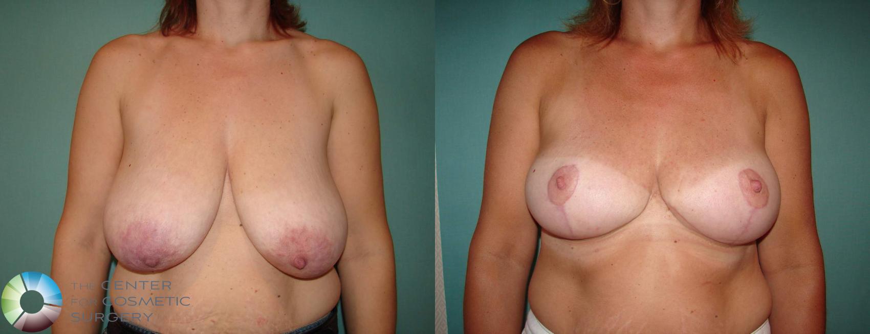 Before & After Breast Reduction Case 547 View #1 View in Denver & Golden, CO
