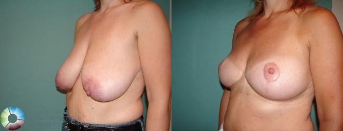 Before & After Breast Reduction Case 547 View #2 View in Golden, CO