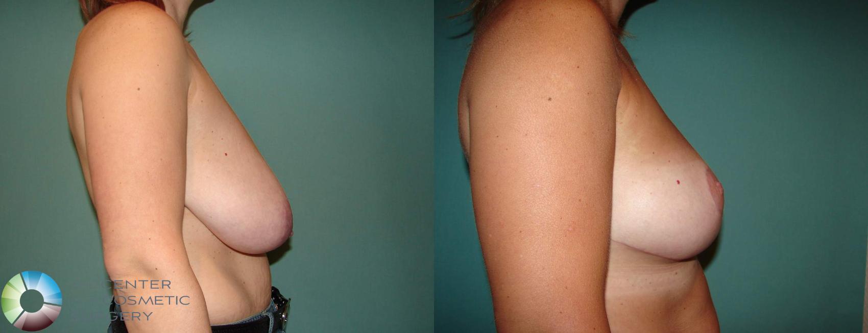 Before & After Breast Reduction Case 547 View #3 View in Denver & Golden, CO