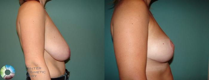 Before & After Breast Reduction Case 547 View #3 View in Golden, CO