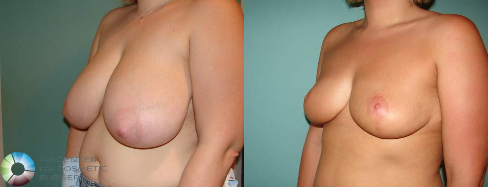 Before & After Breast Reduction Case 576 View #1 View in Golden, CO
